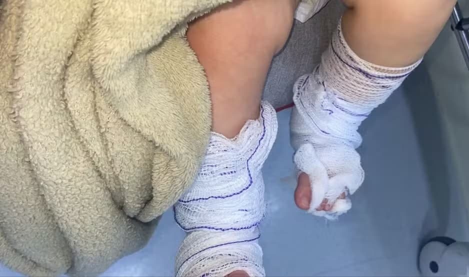 Bebê de 11 meses sofre queimaduras de segundo grau durante banho em Emei de Campo Bom